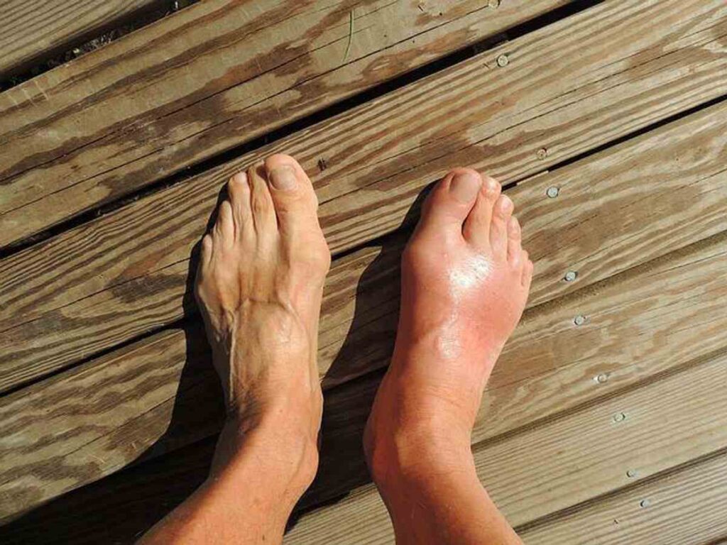 What Is Gout