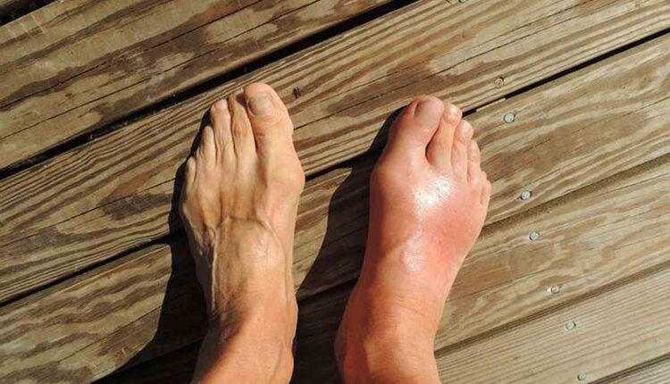 What Is Gout