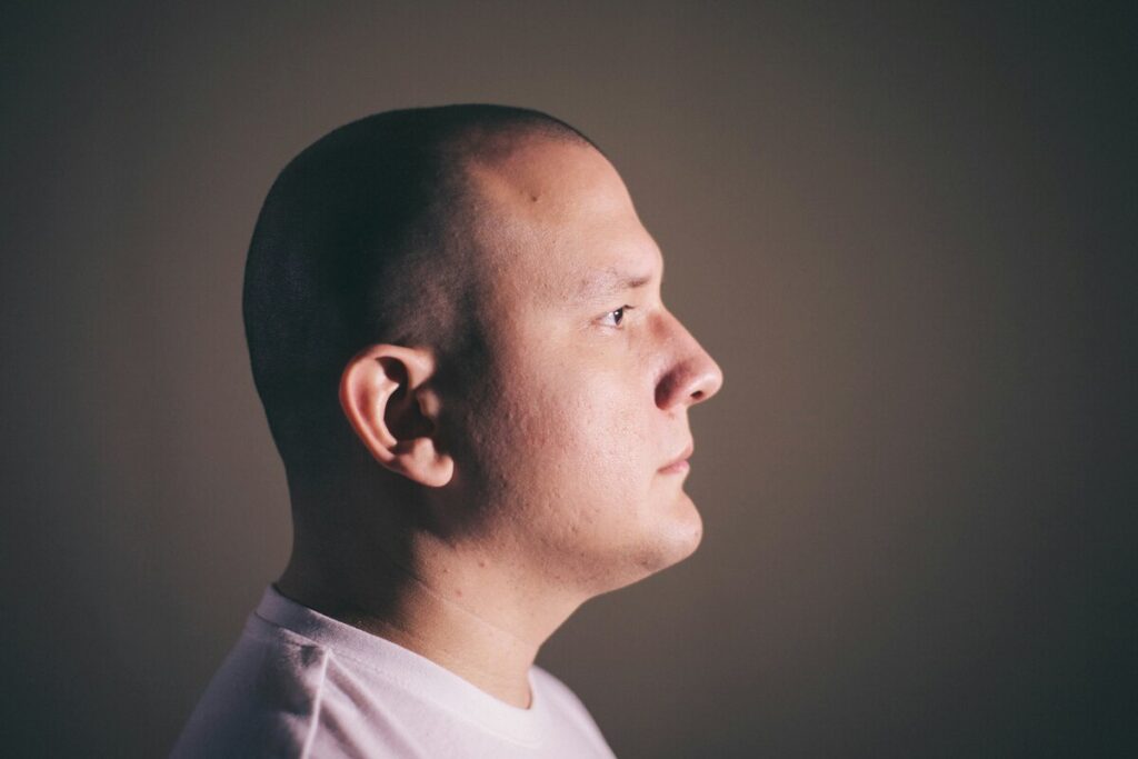 Hair transplant in Turkey